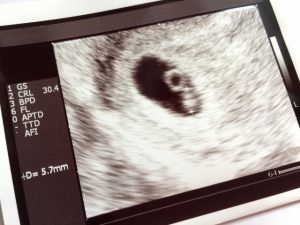 確認 いつ 胎嚢 心拍確認したらひと安心って本当？妊娠何週でわかるの？確認後の流産の可能性について｜Milly ミリー